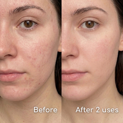 PATCHFACE™ The Original Full Face Pimple Patch
